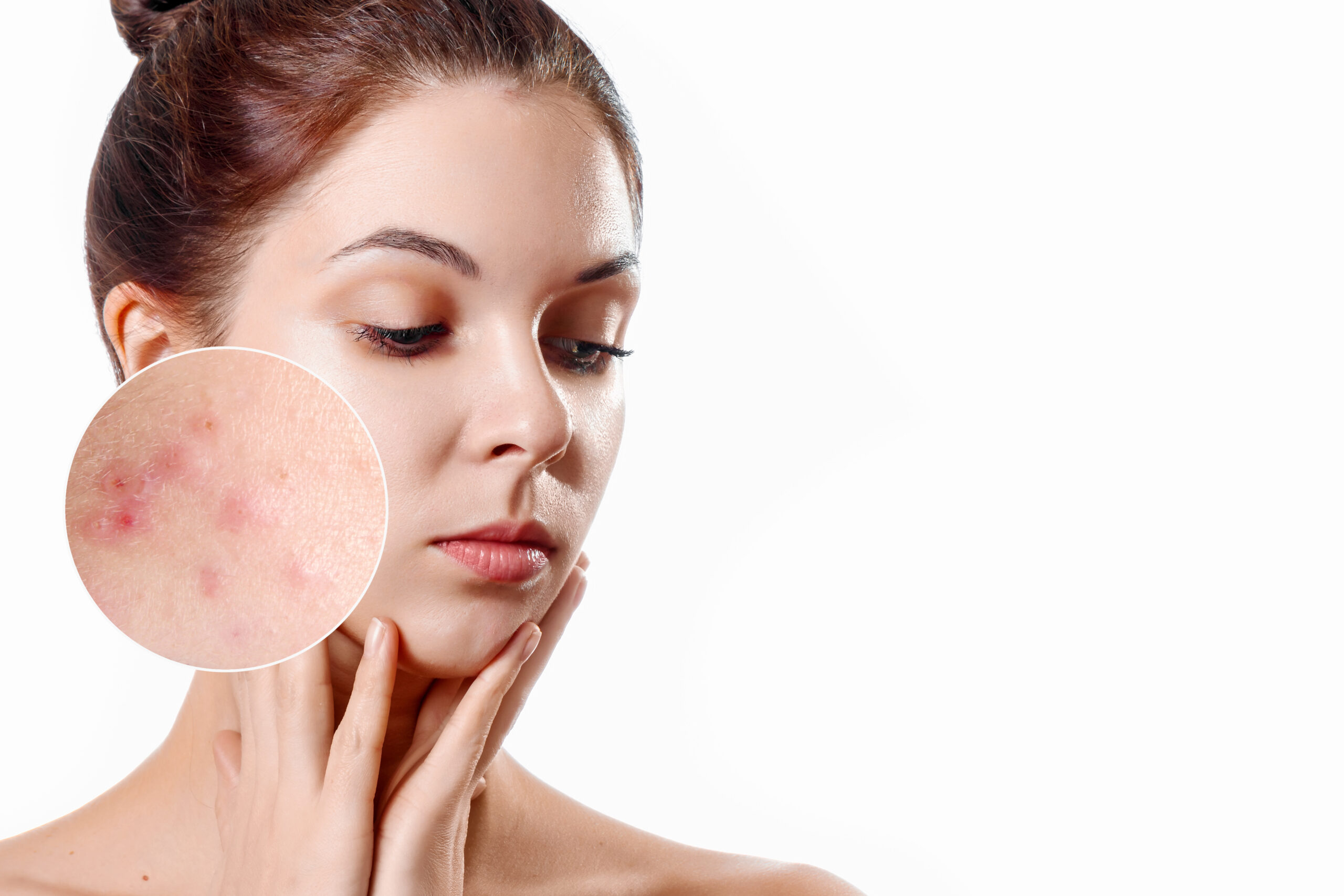 Young woman with acne skin in zoom circle. Skin care concept. Young girl, beauty portrait. Close-up.