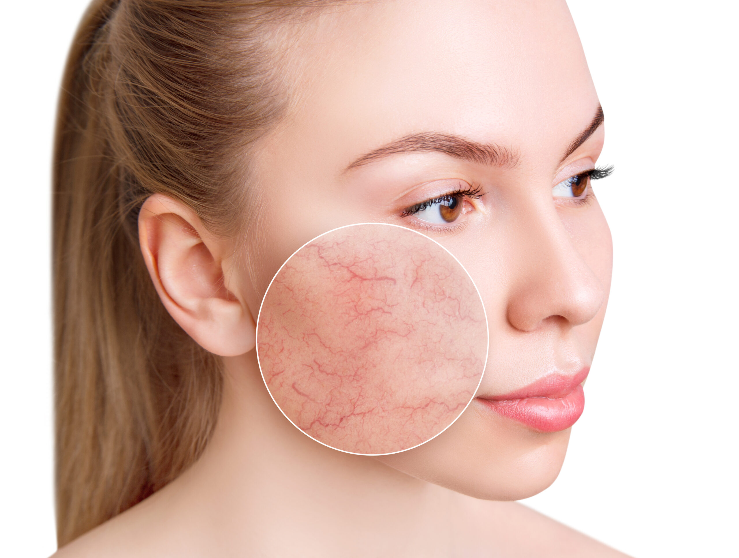Young woman with couperose on face skin.